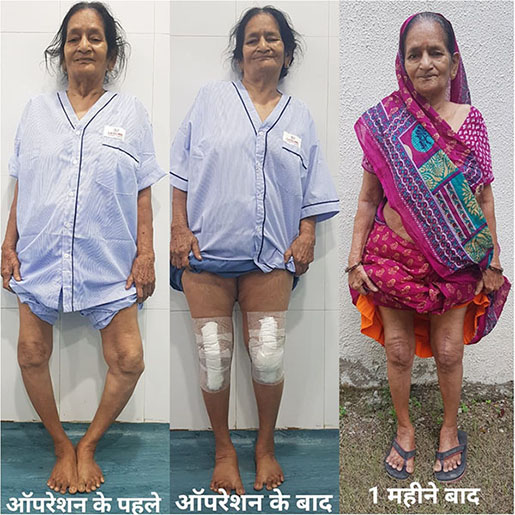 Knee replacement case 11