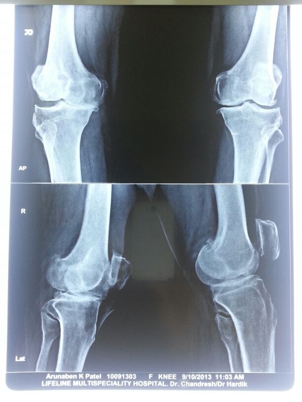 Knee replacement case 13