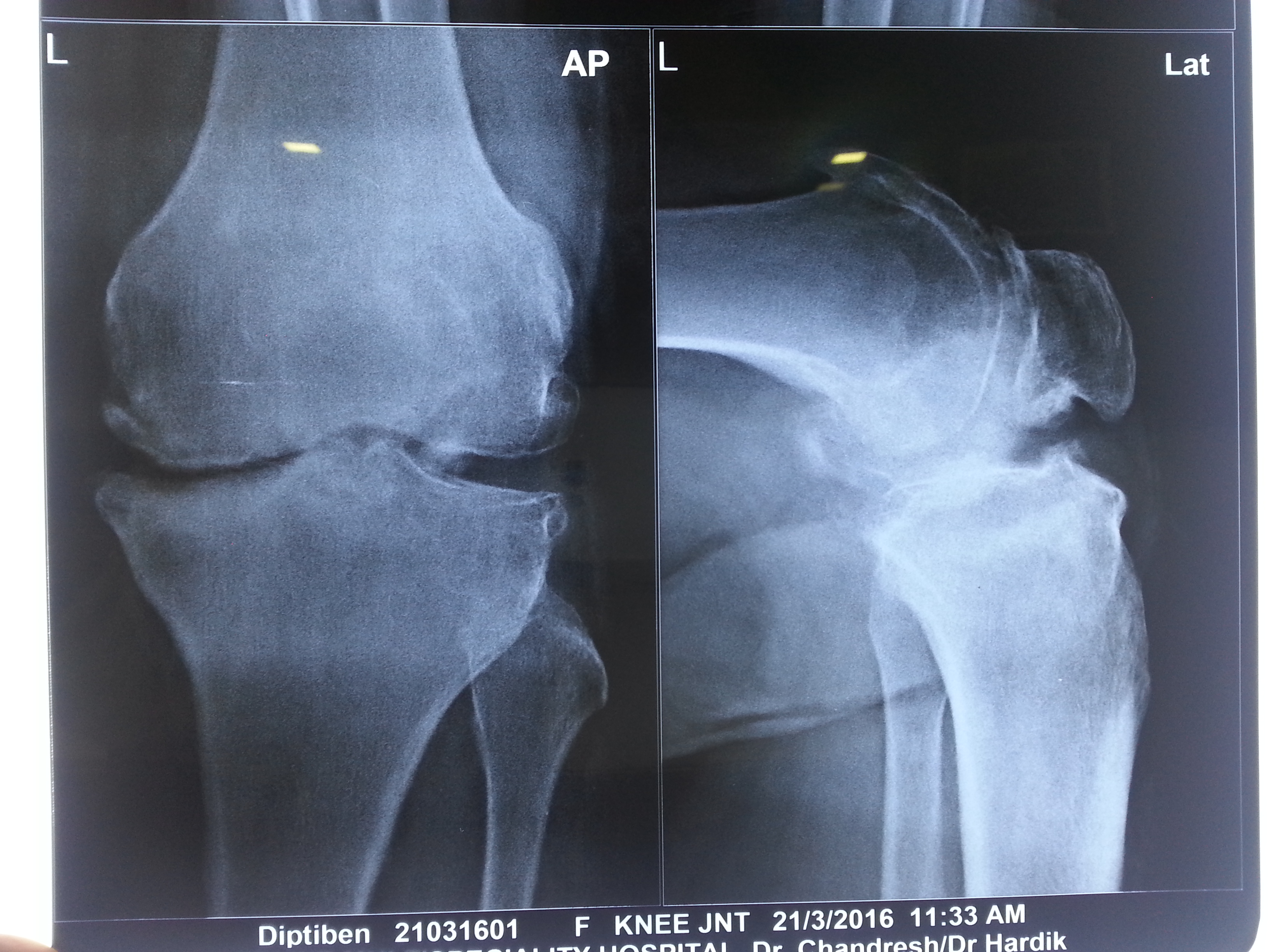Knee replacement case 16