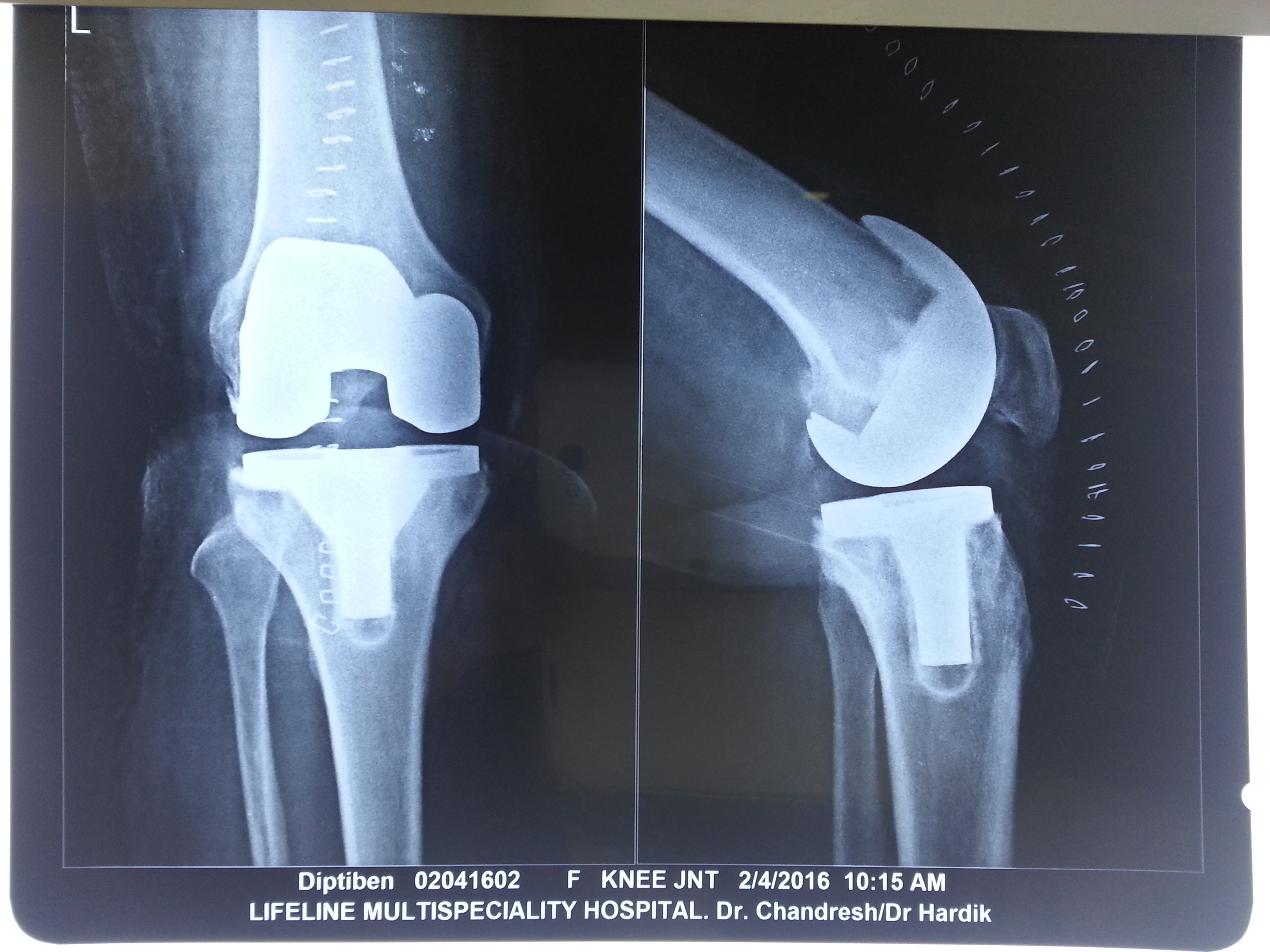 Knee replacement case 17