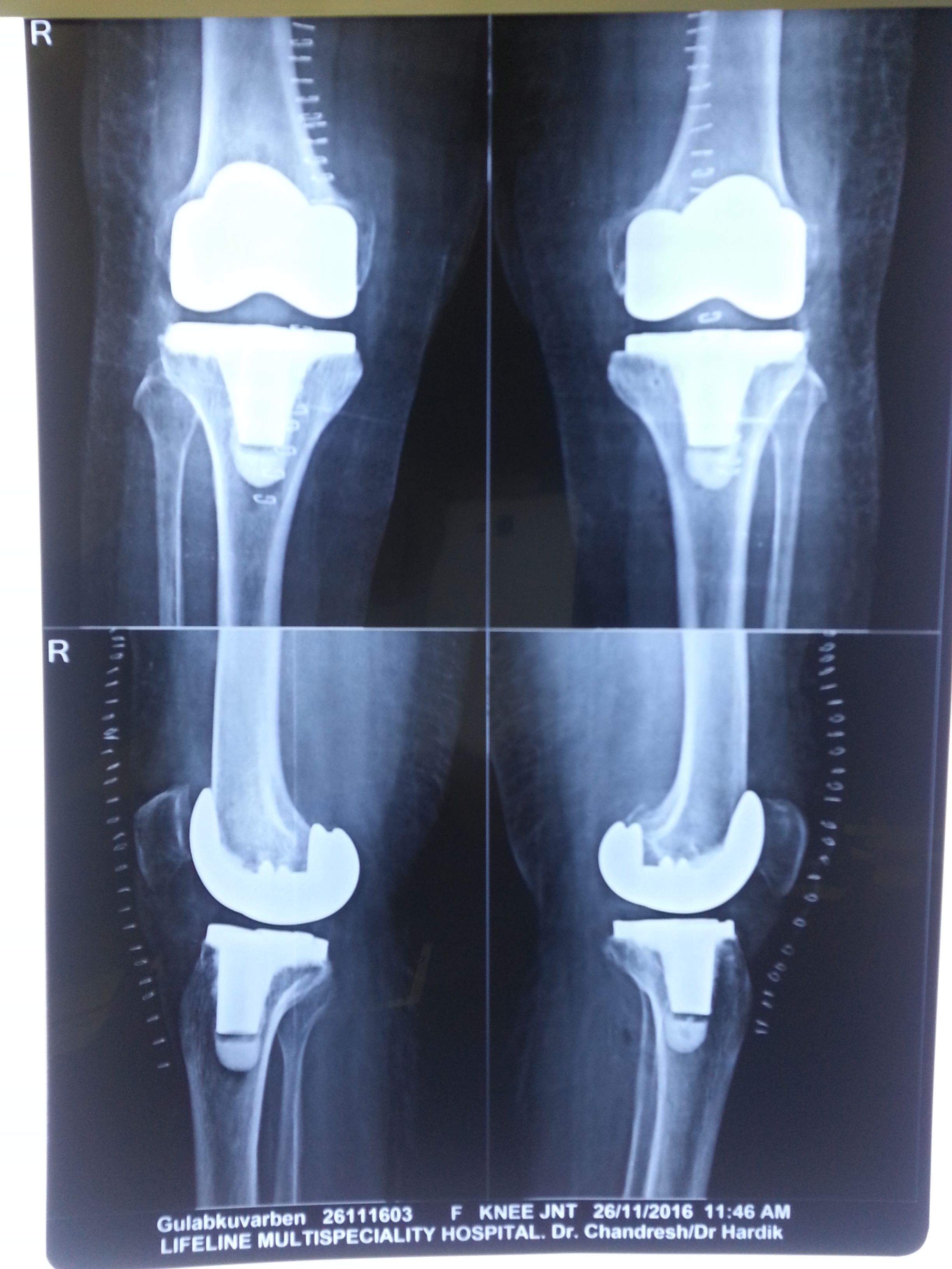 Knee replacement case 20