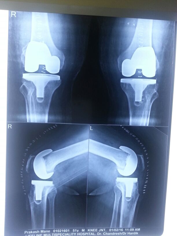 Knee replacement case 25