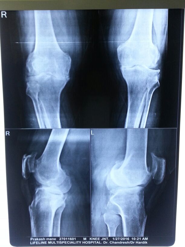 Knee replacement case 26
