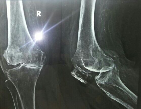 Knee replacement case 28
