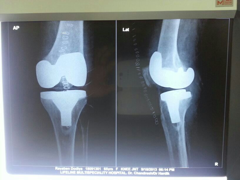 Knee replacement case 29