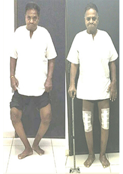 Knee replacement case 3