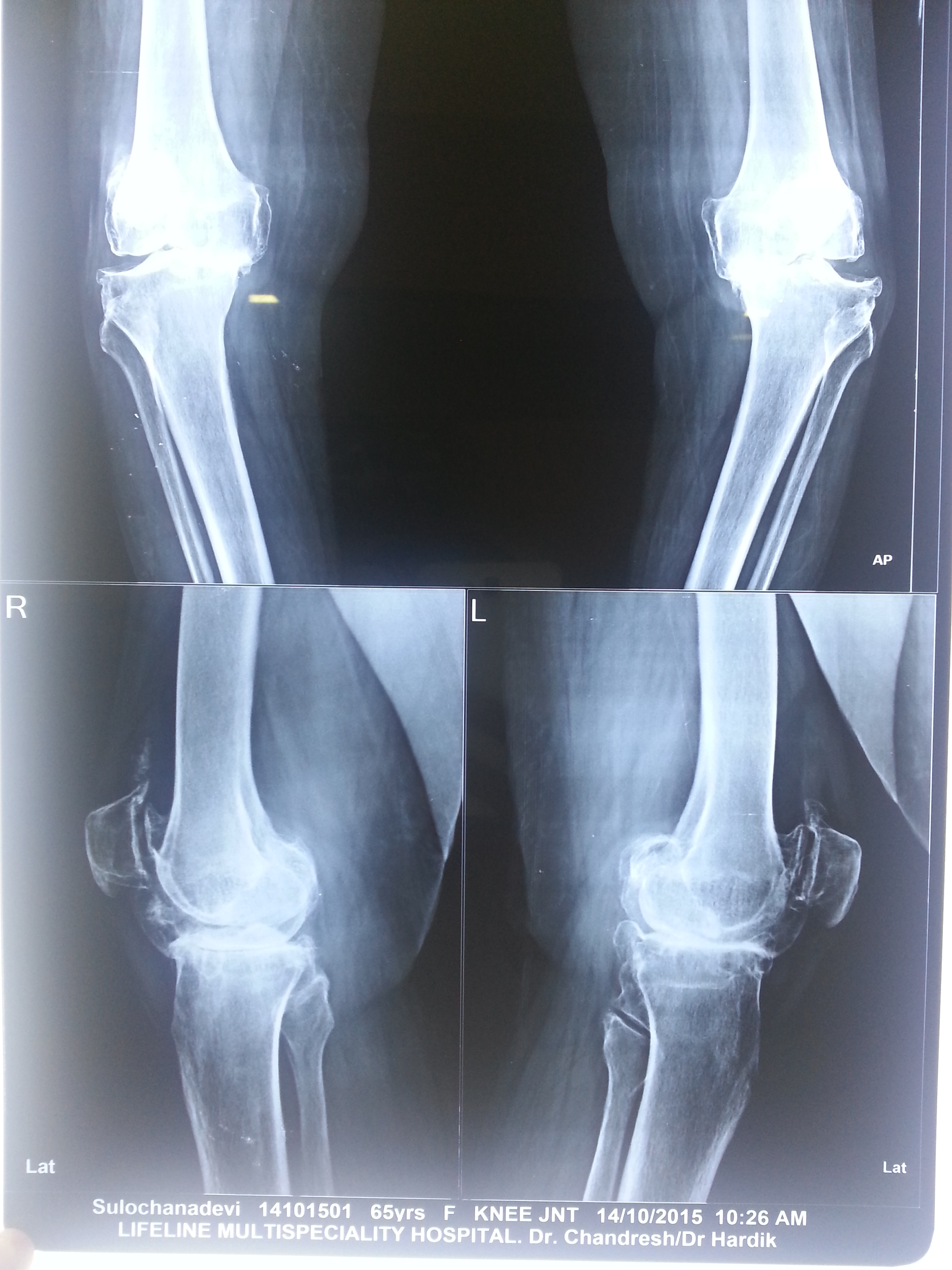 Knee replacement case 32