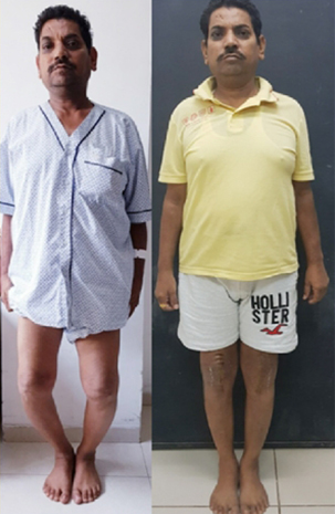 Knee replacement case 36