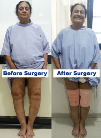 Knee replacement case 40