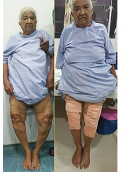 Knee replacement case 41