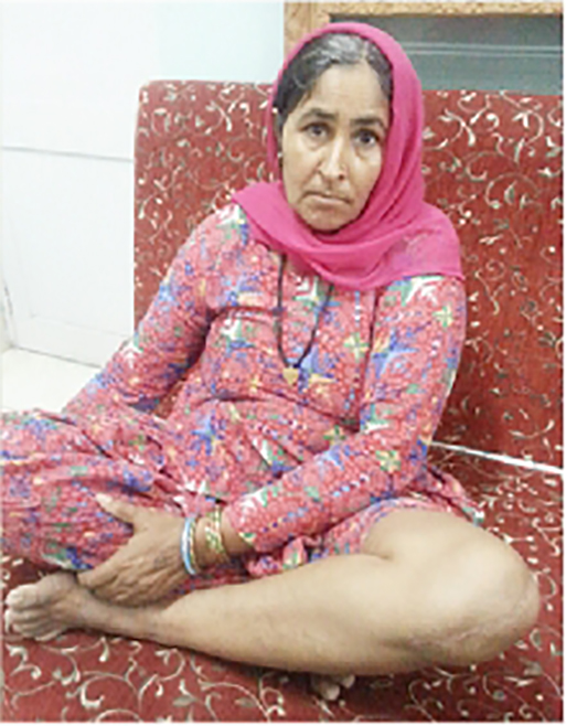 Knee replacement case 42