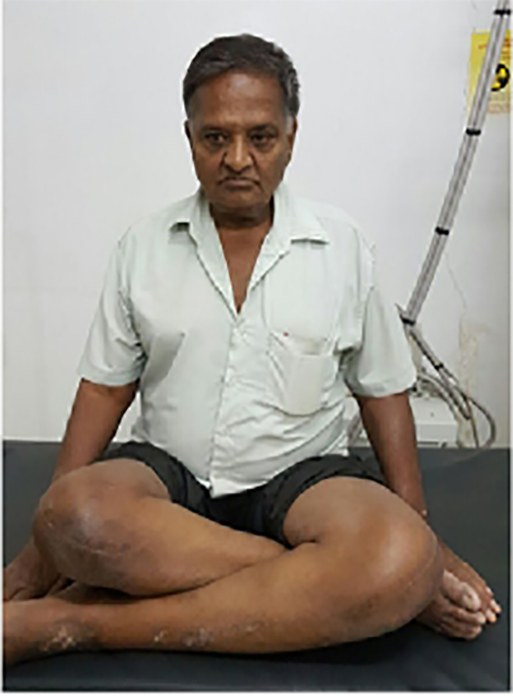 Knee replacement case 45