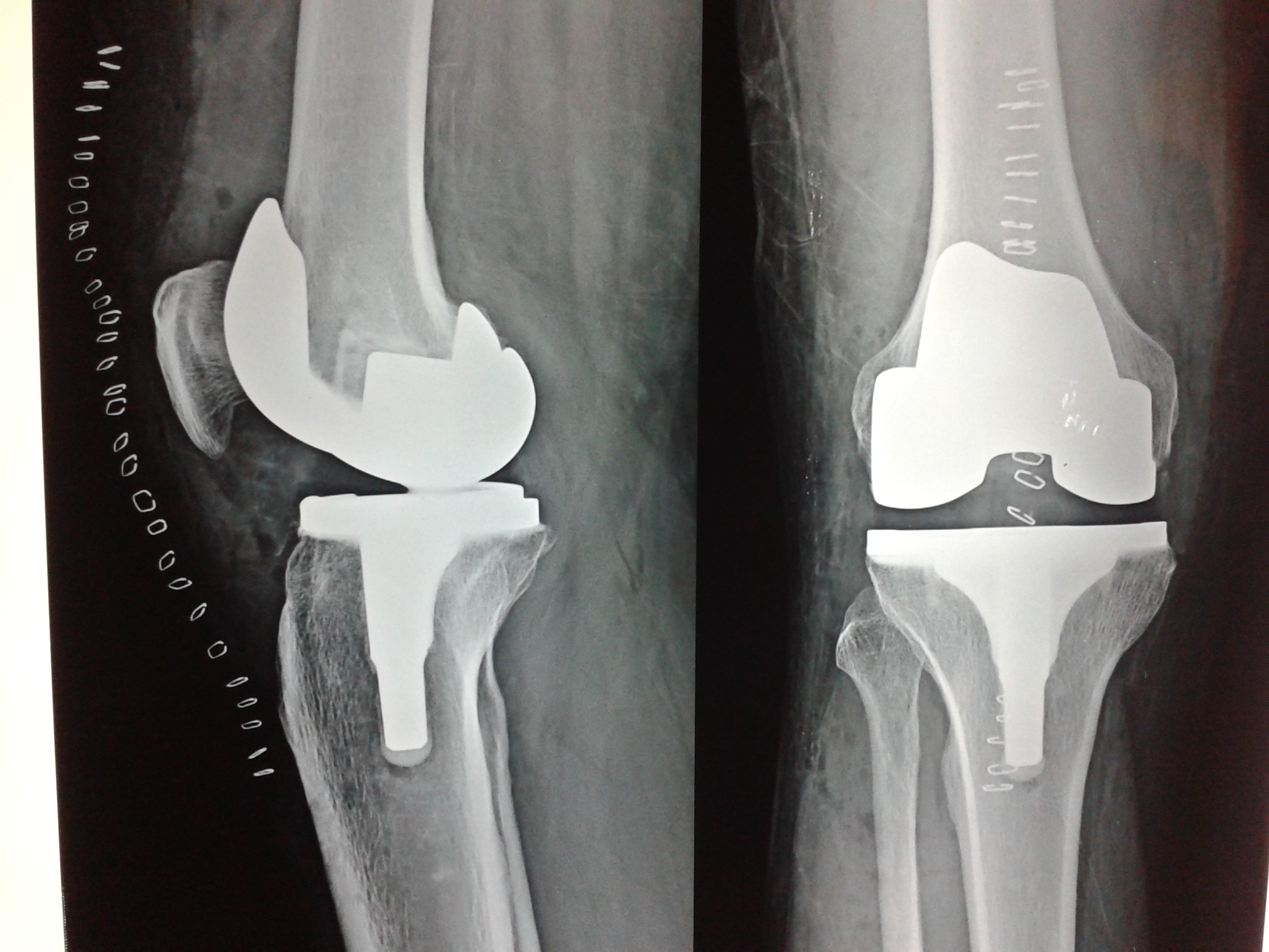 Knee replacement case 7