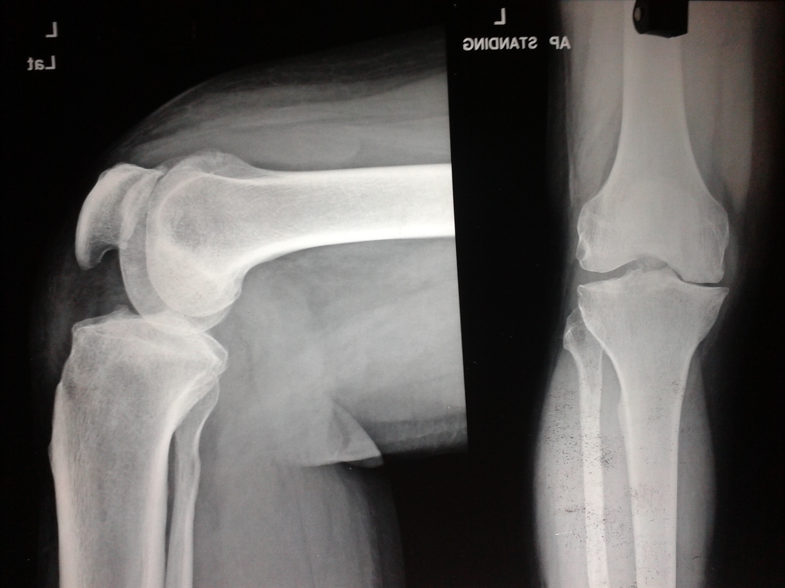 Knee replacement case 8