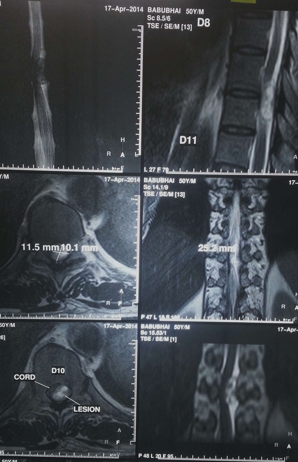 Bone tumour X-ray before and after treatment
