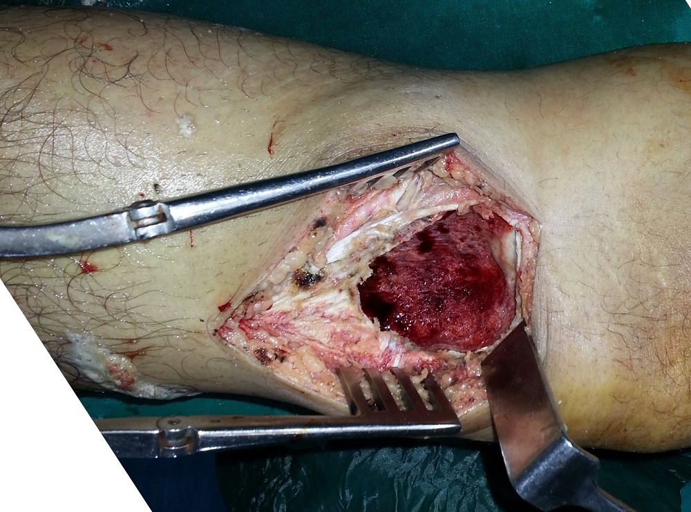 Bone tumour reconstruction X-ray