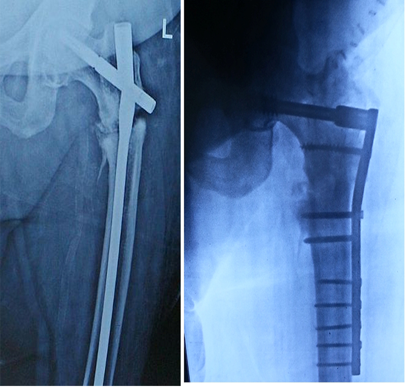 Complex fracture surgery case 12