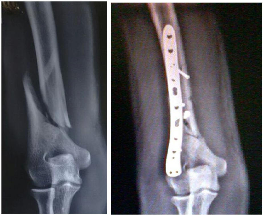 Complex fracture surgery case 13