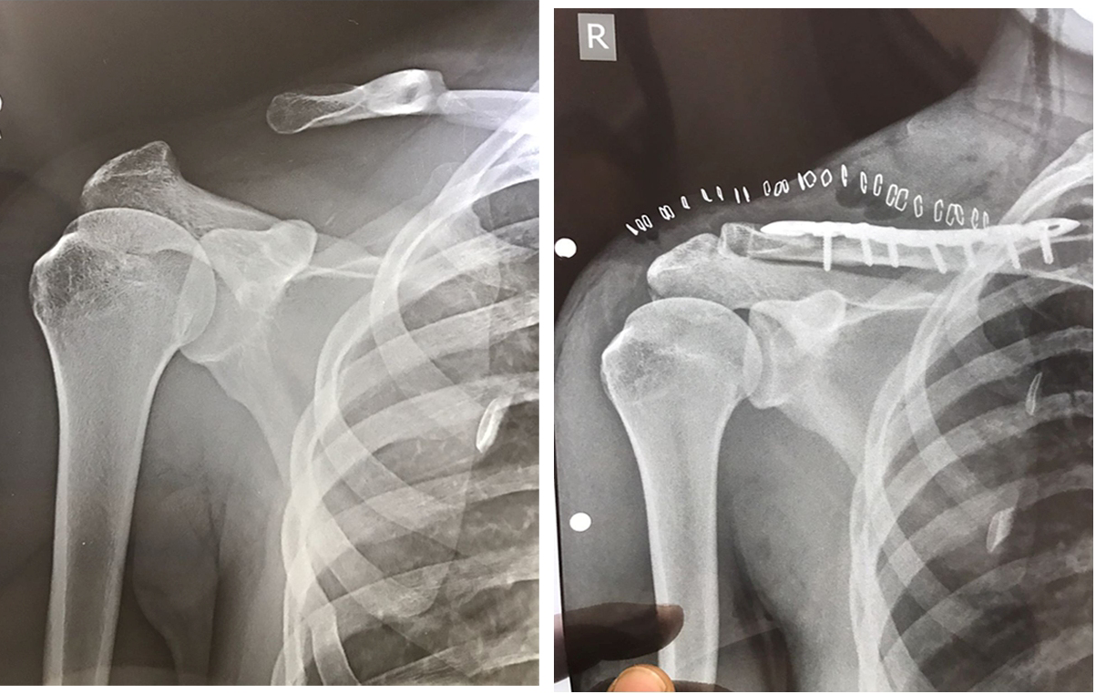 Complex fracture surgery case 15