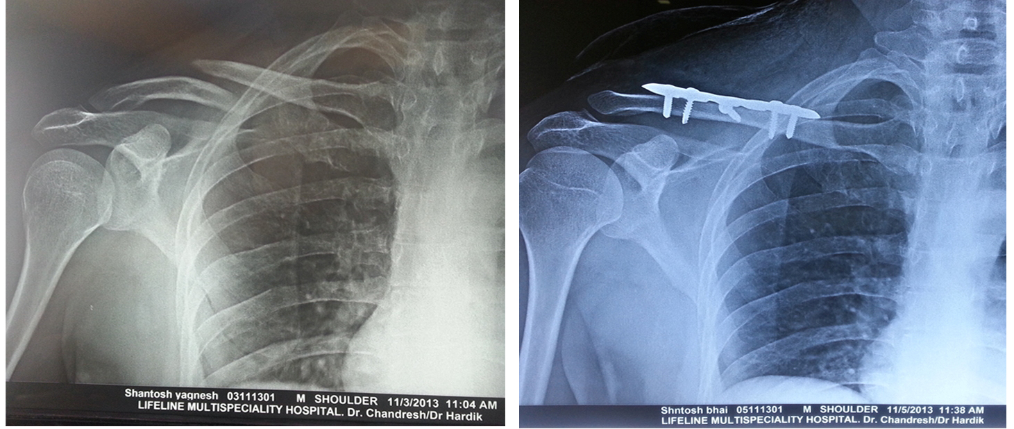 Complex fracture surgery case 3