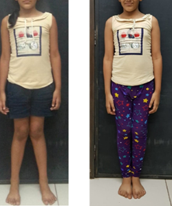 Case 3: Twisted Feet Correction, photo 2