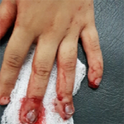 Case 1: Crush Finger Injury In Child, photo 2