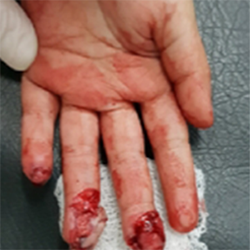 Case 1: Crush Finger Injury In Child, photo 3