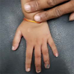 Case 1: Crush Finger Injury In Child, photo 4