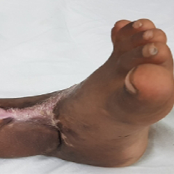 Case 2: Crush Injury Ankle, photo 2