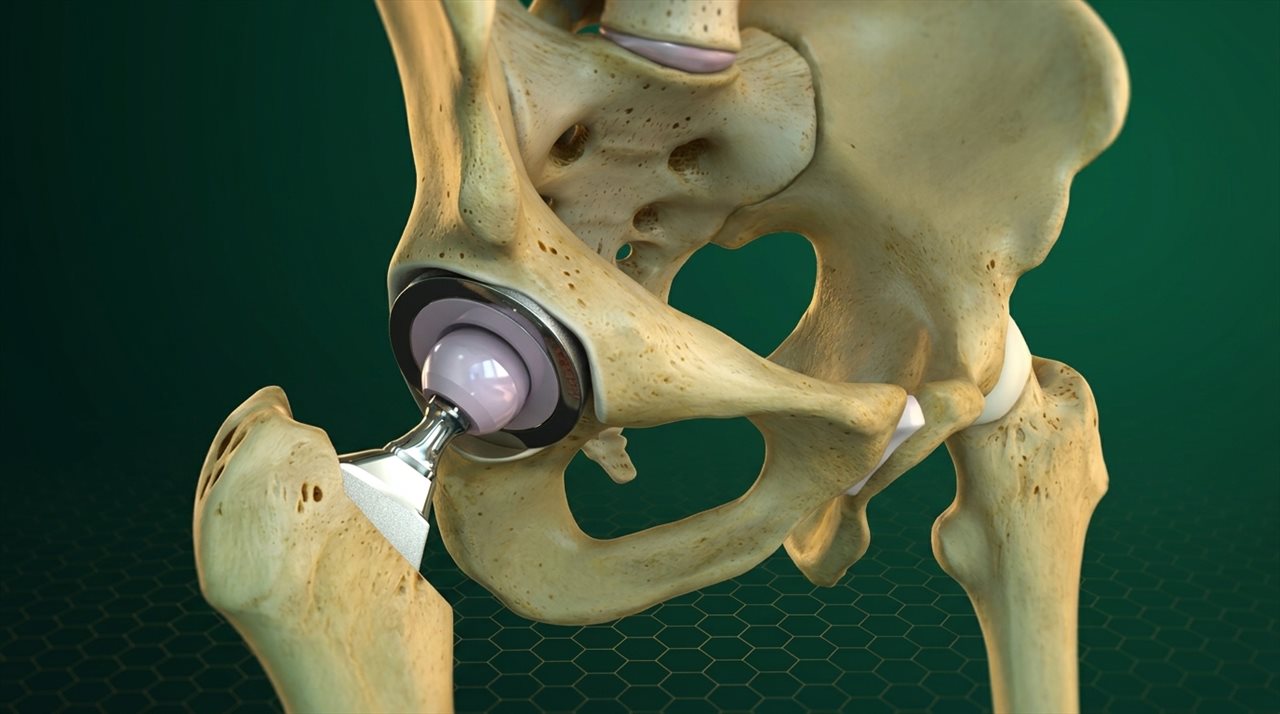Dr. Chandresh Sharma - Themed Hip Joint Replacement Anatomy and Implant Architecture