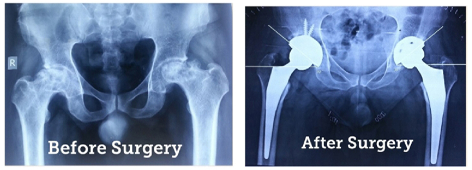 Hip replacement, treated case 10