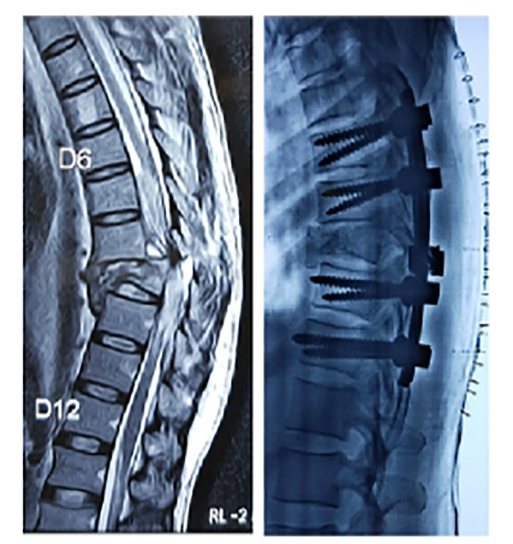 Spine surgery, treated case 4