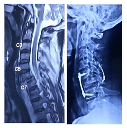 Spine surgery, treated case 5