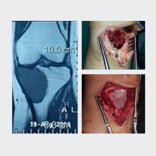 Bone cancer case
