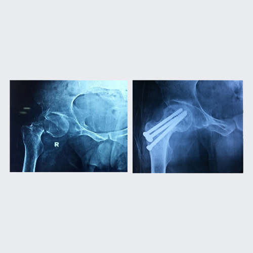 Complex fracture case