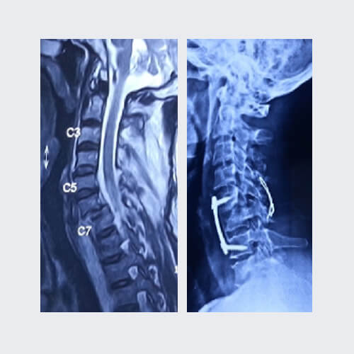Spine surgery case