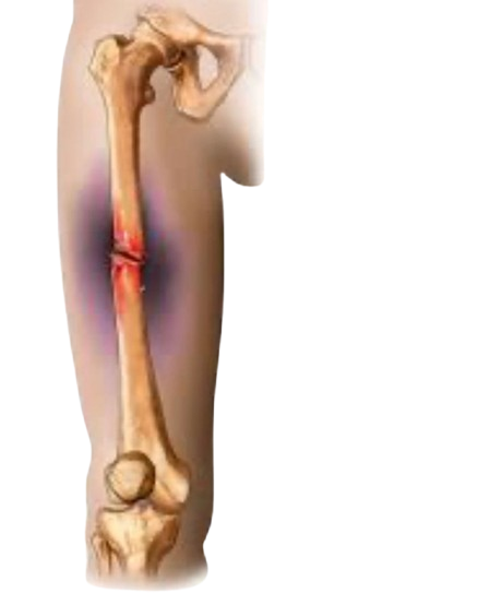 Complex Fracture